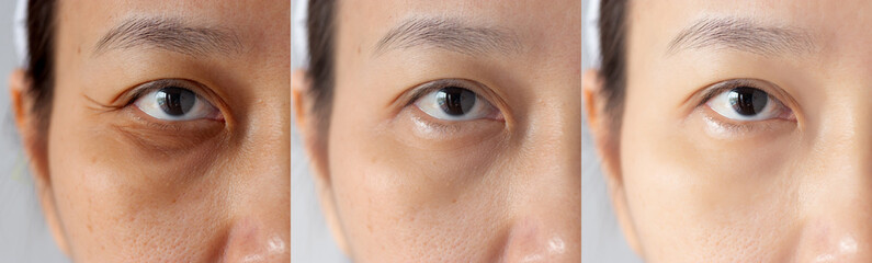 three pictures compared effect Before and After treatment. under eyes with problems of dark circles...