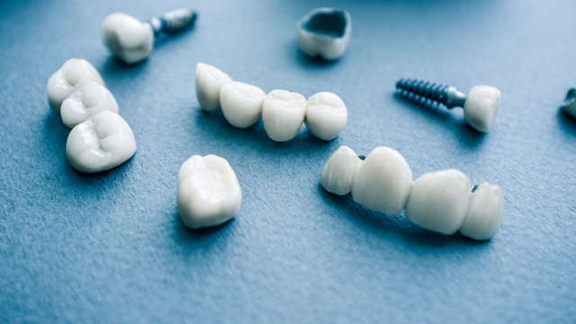 Surgical orthodontics. Teeth reconstruction and prosthodontics. Closeup of dental implants and ceramic dentures.