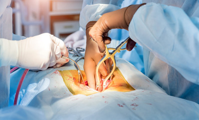 Spinal surgery. Group of surgeons in operating room with surgery equipment. Laminectomy