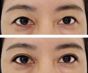 Before and after plastic surgery concept. Double eyelid on asian woman.