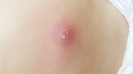 Fototapeta premium close-up abscess on child skin