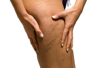 Woman pinching stretch marks and cellulite on her leg on white background