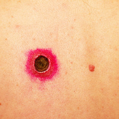 Fototapeta premium wound after removing moles on the female back treated with fucorzin