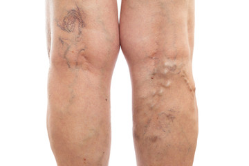 Fototapeta na wymiar Legs with swollen veins and varicose