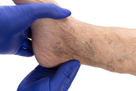 Doctor Examining Varicose Veins On Ankle