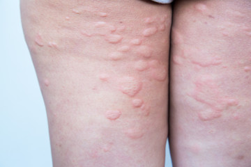 Skin rash in the legs