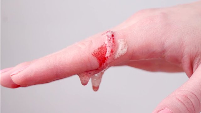 A woman treats an open bleeding wound on her hand with a disinfectant