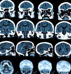 Mri Brain Scan