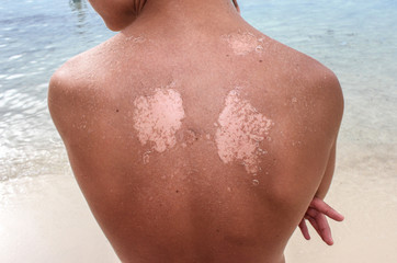 Close up detail of a very bad sunburn showing the peeling skin of a mans back.