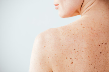 cropped view of diseased and naked woman with moles on skin on white - obrazy, fototapety, plakaty