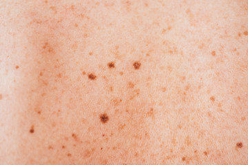 close up of sick woman with melanoma on diseased skin