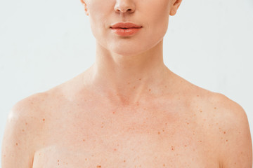 cropped view of nude woman with melanoma isolated on white