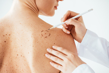 cropped view of dermatologist applying marks on skin of naked woman with melanoma isolated on white - obrazy, fototapety, plakaty