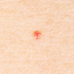 Fototapeta premium Birthmark on human skin.