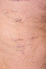 Close-up of an elderly woman's leg, which develops a disease of varicose veins