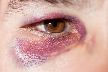 Obraz premium Man's face after the fight and assault. Middle-aged Caucasian male Emotional Portrait with a Real Bruise after the fight. Violence.