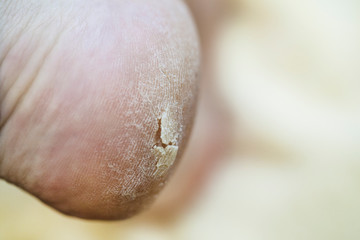 Naklejka premium foot care, cracked skin on heels, close-up