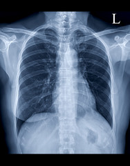 Chest X-ray or X-Ray Image Of Human  for detect heart disease and lung disease . check up concept.