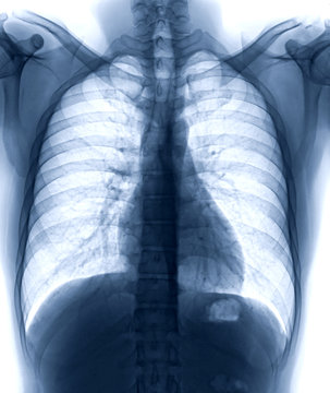 Chest X-ray or X-Ray Image Of Human with full inspiration for detect heart disease and lung disease . check up concept.