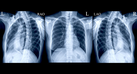 collection Chest X-ray or X-Ray Image Of Human AP and both oblique view for detect fracture Rib...