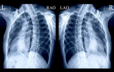 Chest X-ray or X-Ray Image Of Human both oblique view or both side for detect fracture Rib from...