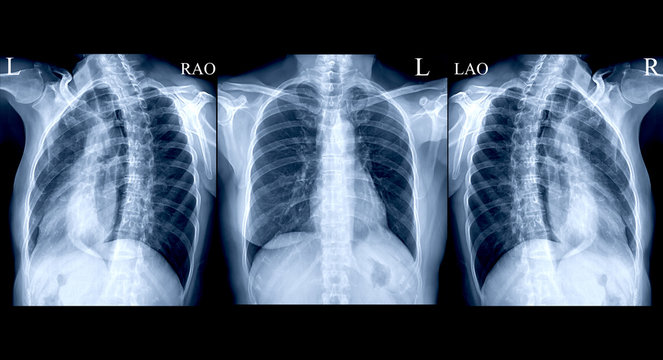 collection Chest X-ray or X-Ray Image Of Human AP and both oblique view for detect fracture Rib from case trauma .
