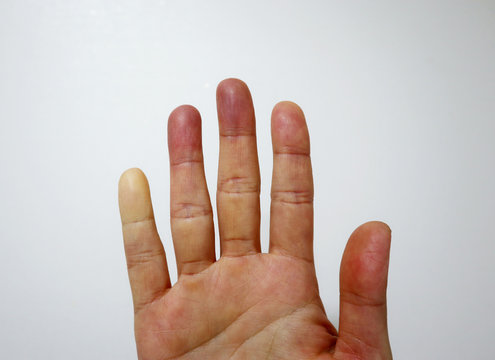 raynauds disease