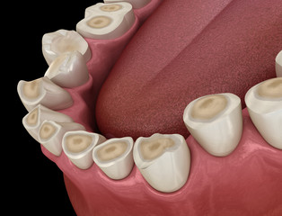 Dental attrition (Bruxism) resulting in loss of tooth tissue.  Medically accurate tooth 3D illustration