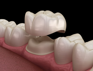 Preparated molar tooth for dental crown placement. Medically accurate 3D illustration
