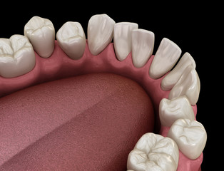 Abnormal teeth position, orthodontic concept. Medically accurate tooth 3D illustration