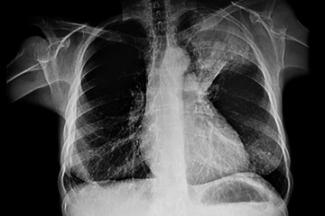 X - Ray of Left upper lung tumor