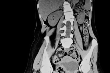Obraz premium CAT Scan of the abdomen