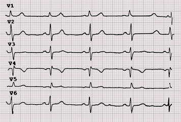 Cardiogram. Heartbeat. The graph on graph paper.