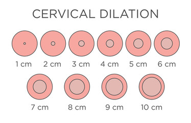 Cervial Dilation Medical Illustration - chart in centimeters