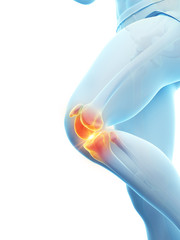 3d rendered medically accurate illustration of a painful knee - obrazy, fototapety, plakaty