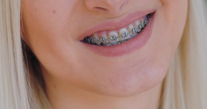Braces, smile, mouth closeup.