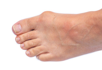 Foot of a woman with painful Hallux Valgus