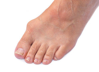 Foot of a woman with painful Hallux Valgus