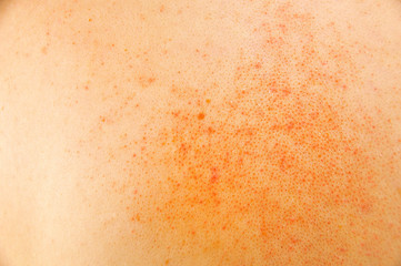 atopic dermatitis on the skin