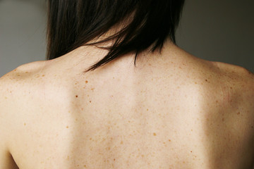 freckles and moles on the girl's back