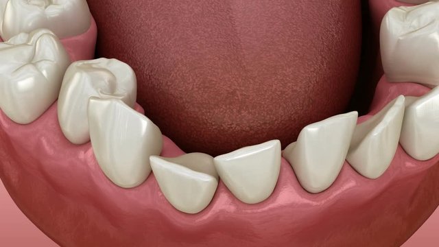 Abnormal teeth position, orthodontic concept. Medically accurate tooth 3D animation