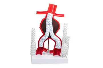 Model aneurysm treatment with endovascular fenestrated and branched stent-grafts.