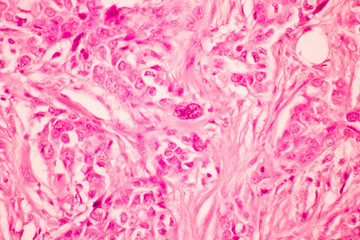 View in microscopic of pathology section ductal cell carcinoma or adenocarcinoma diagnosis by pathologist in laboratory.Criteria of breast cancer.Medical concept