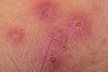 Wound infection on the skin, Skin lesions, Impetigo, Ecthyma, Pressure