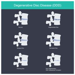Degenerative Disc Disease.
