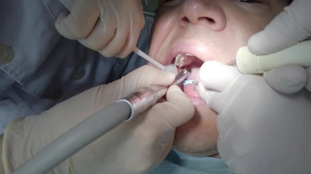 Mouth of root canal patient. Closeup of dentist and assistant performing operation on patient's teeth. Inside the mouth of dental surgery. Lying on chair for checkup at dentists office.
