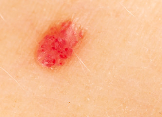 Birthmark on human skin.