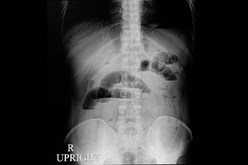  abdominal xray film of a patient with small bowel obstruction