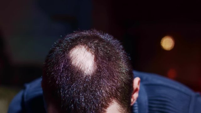Thoughtful man with bald patches on his head