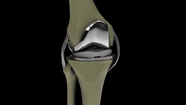 Human knee with knee replacement isolated on a black background 4k video 3d render
